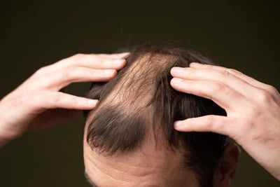 Hair loss and baldness in men