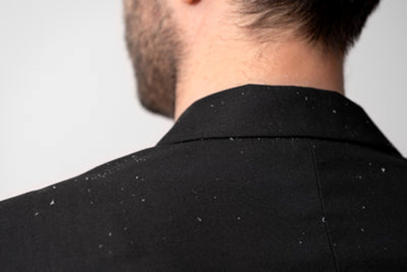 Pityriasis capitis | Dandruff