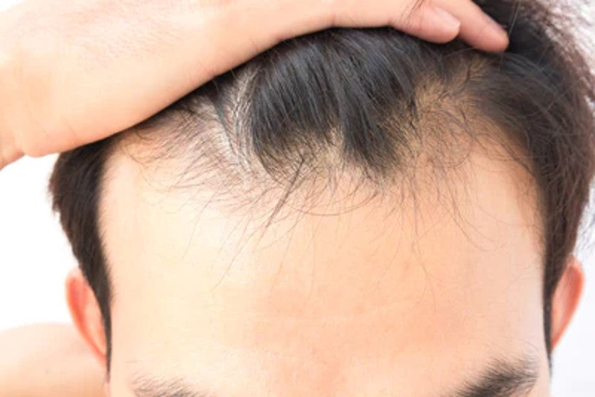 Uneven Hairline