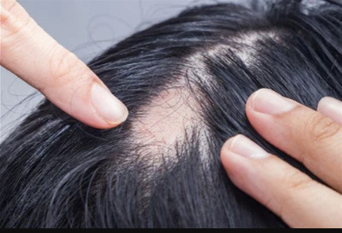 Alopecia Areata in Women