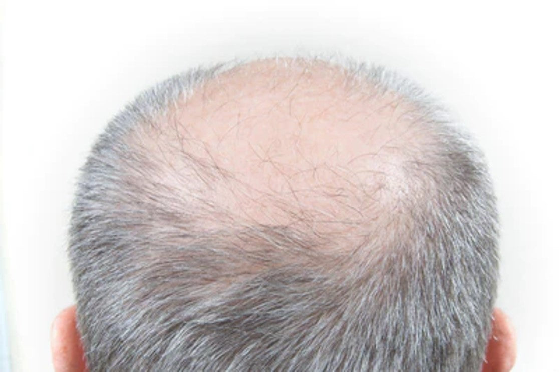 Balding spots on head