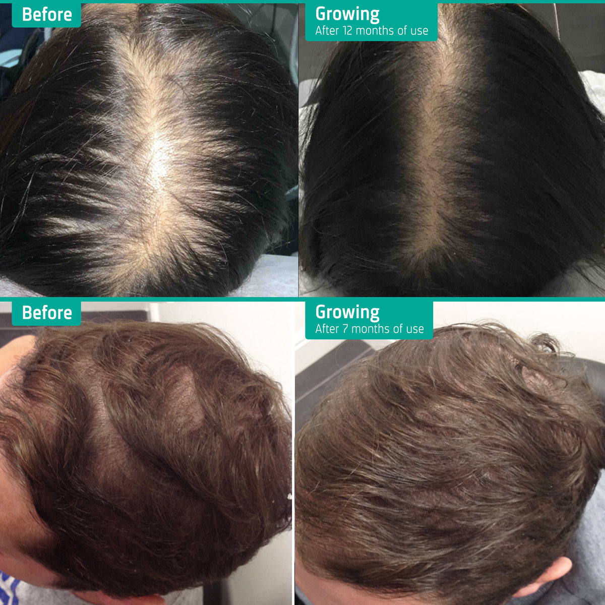 Treatment for Thinning Hair